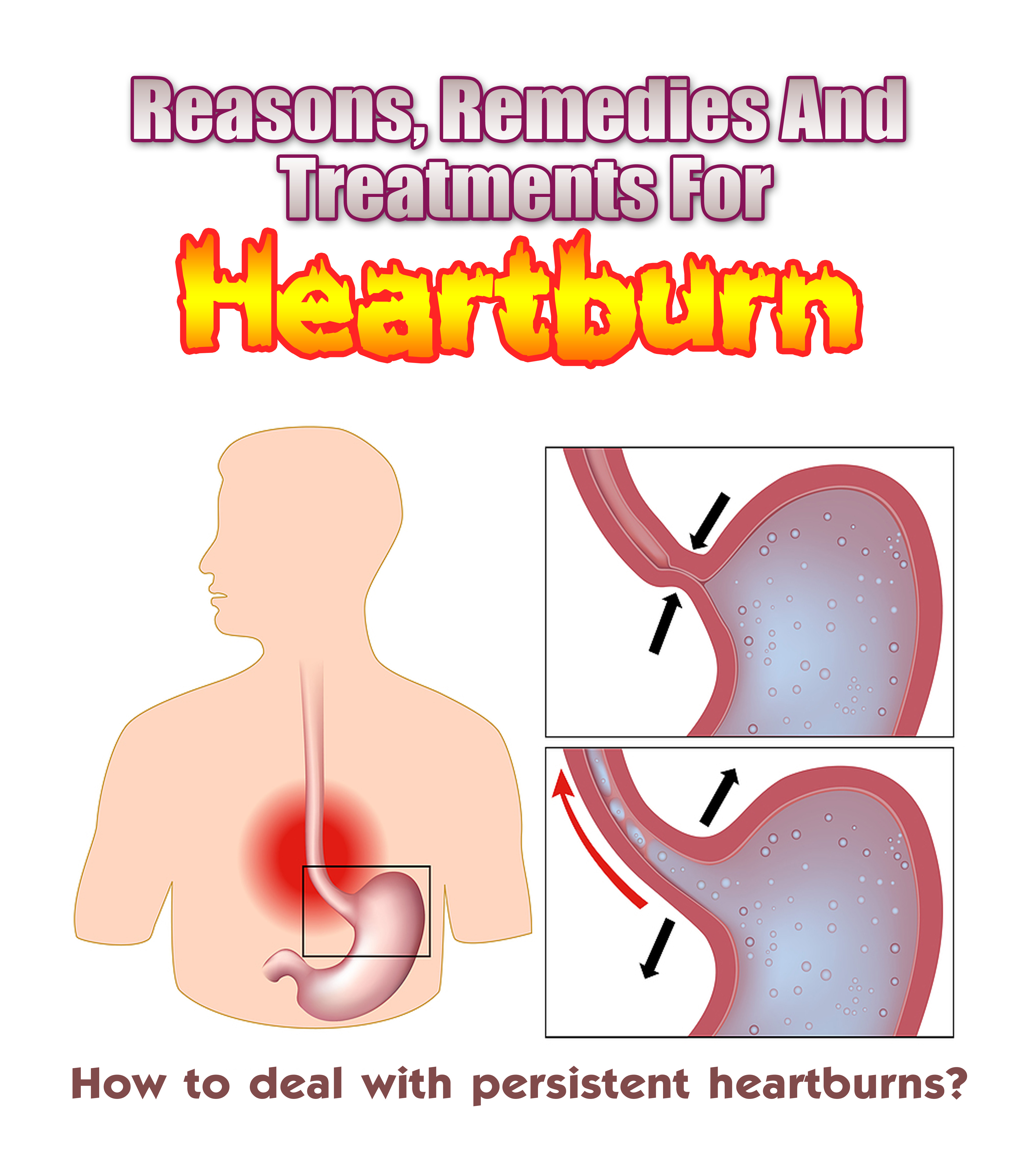 Reasons, Remedies And Treatments For Heartburns